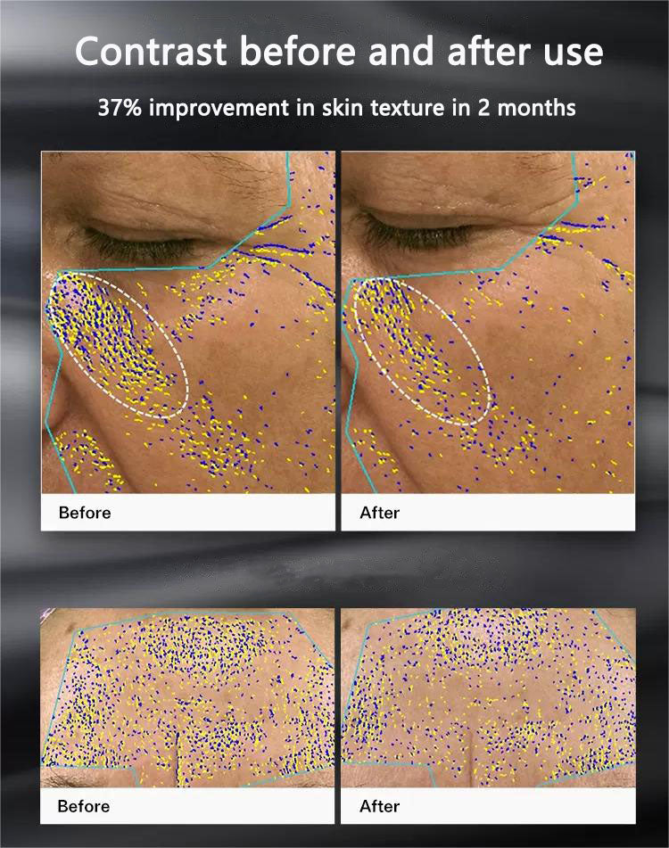 ENVIG EDGE 射頻美容儀 改善膚質皮膚緊緻改善膚色減少魚尾紋 halohk